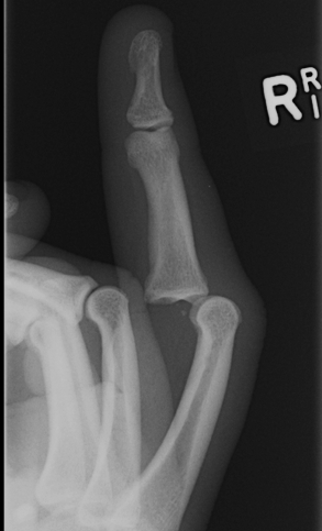 Finger Volar Dislocation